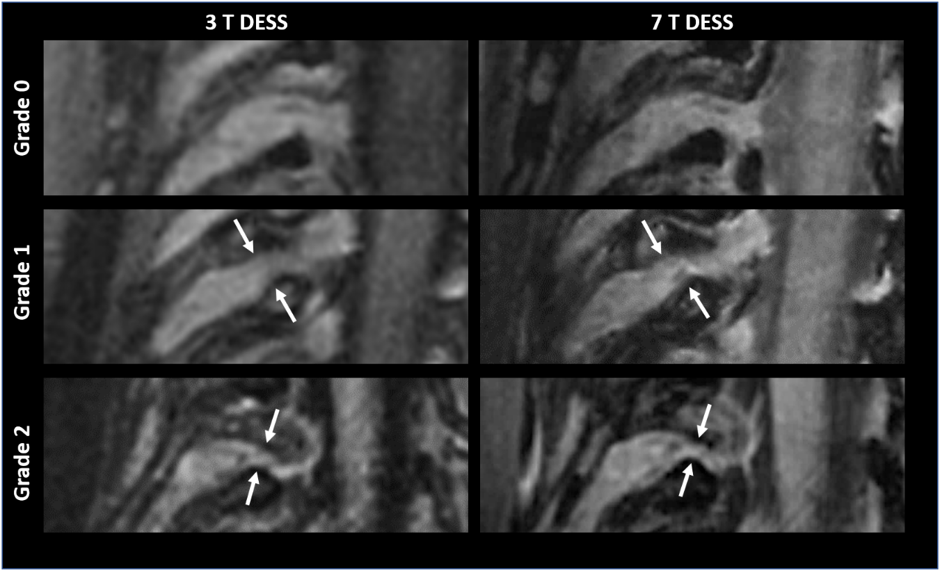 Nerve Root Compression in the Cervical Spine at 3T MRI and 7T MRI